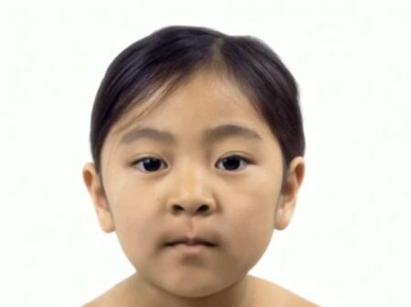 Timelapse shows braces straightening teeth over 18 months
